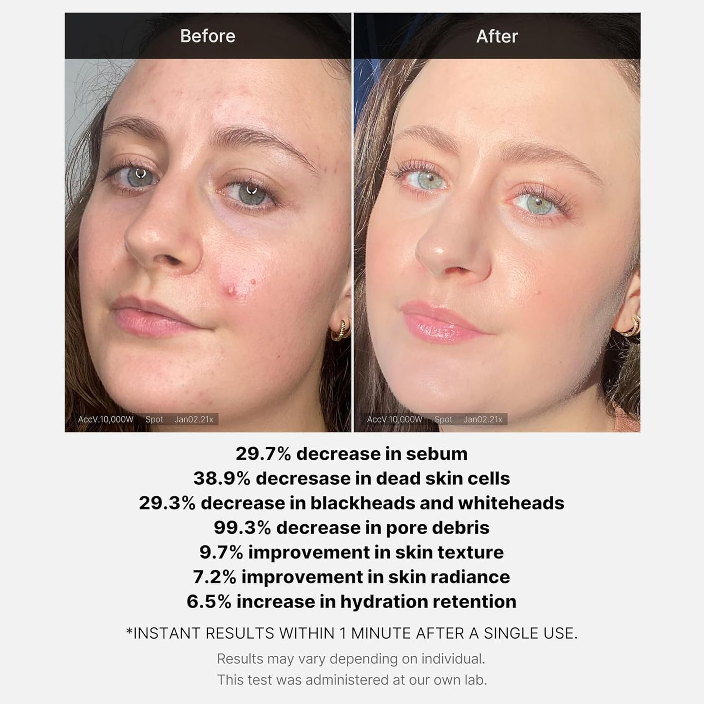 Medicube - Red Acne Succinic Acid Peel (AHA+BHA+Succinic Acid), Wash-off Resurfacing Serum, Best for bumpy, breakout-prone skin, Korean Skincare - 40g Корейска Козметика За Лице, 
Висок Клас Корейска Козметика, 
Професионална Корейска Козметика, before,after