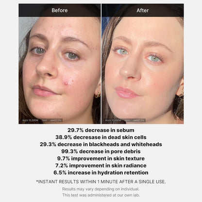 Medicube - Red Acne Succinic Acid Peel (AHA+BHA+Succinic Acid), Wash-off Resurfacing Serum, Best for bumpy, breakout-prone skin, Korean Skincare - 40g Корейска Козметика За Лице, 
Висок Клас Корейска Козметика, 
Професионална Корейска Козметика, before,after